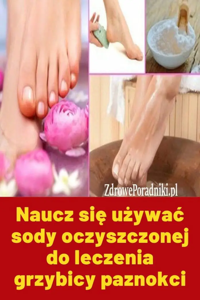 Naucz Si U Ywa Sody Oczyszczonej Do Leczenia Grzybicy Paznokci