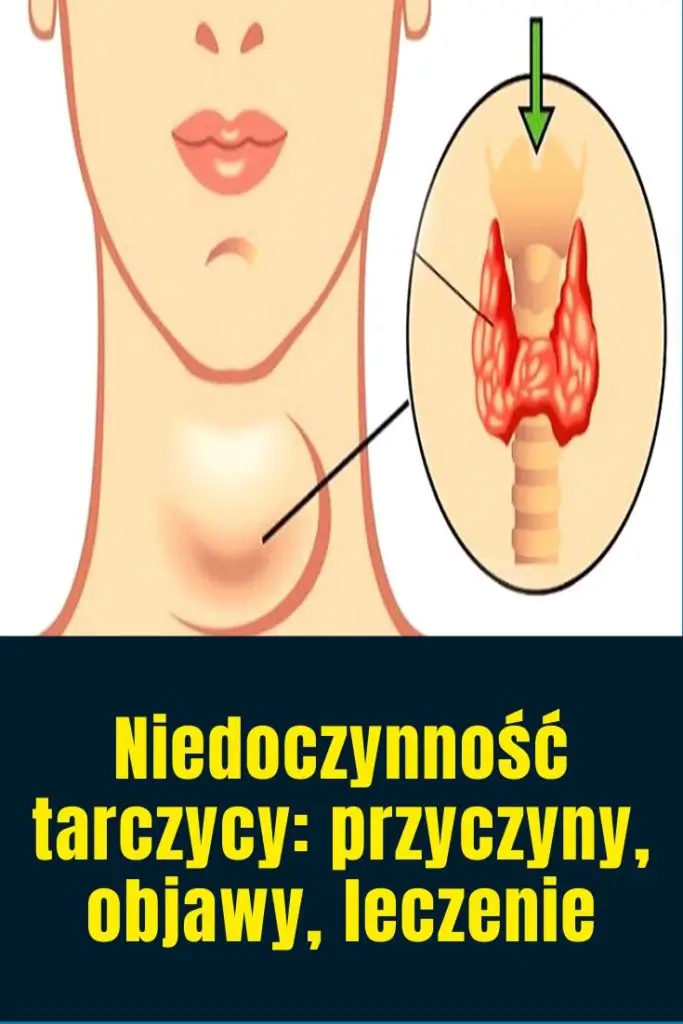 Niedoczynno Tarczycy Przyczyny Objawy Leczenie