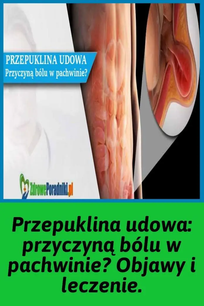 Przepuklina Udowa Przyczyn B Lu W Pachwinie Objawy I Leczenie