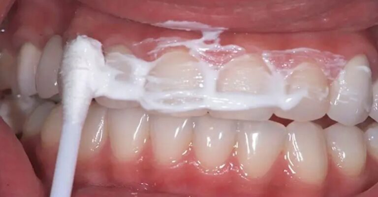 kamień nazębny nowy