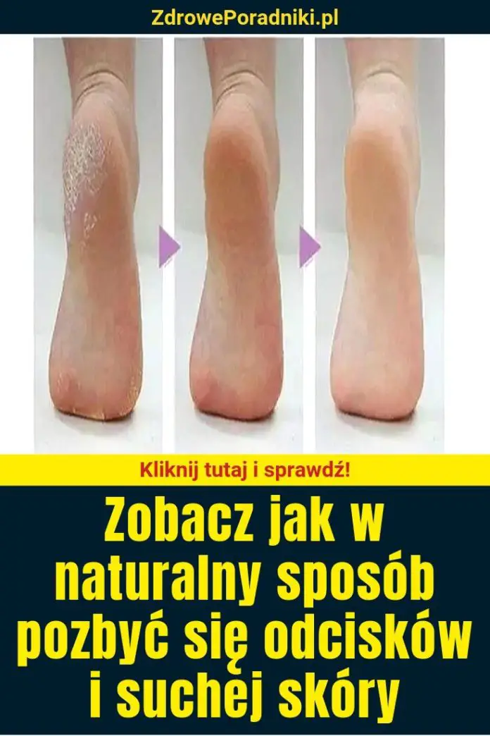 Zobacz Jak W Naturalny Sposób Pozbyć Się Odcisków I Suchej Skóry 5284