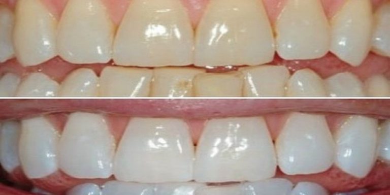 jak szybko wybielic zeby