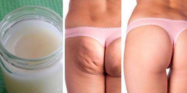 suwanie roztepow i cellulitu