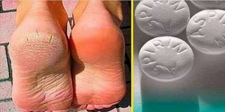 WYELIMINUJ żylaki odciski