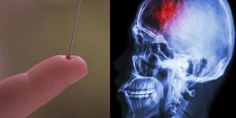 udar mozgu jak zapobiec