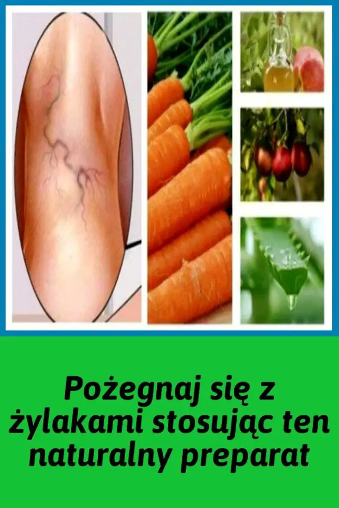 Pożegnaj Się Z żylakami Stosując Ten Naturalny Preparat 5562