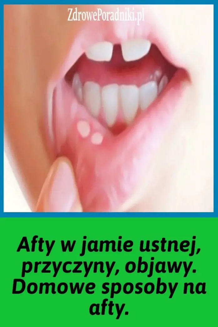 Afty W Jamie Ustnej Przyczyny Objawy Domowe Sposoby Na Afty 1457