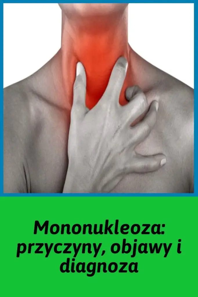 Mononukleoza Przyczyny Objawy Diagnoza I Leczenie