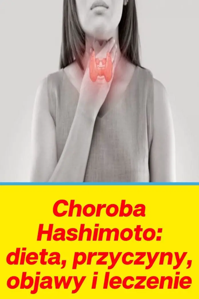 Choroba Hashimoto Dieta Przyczyny Objawy I Leczenie 0396