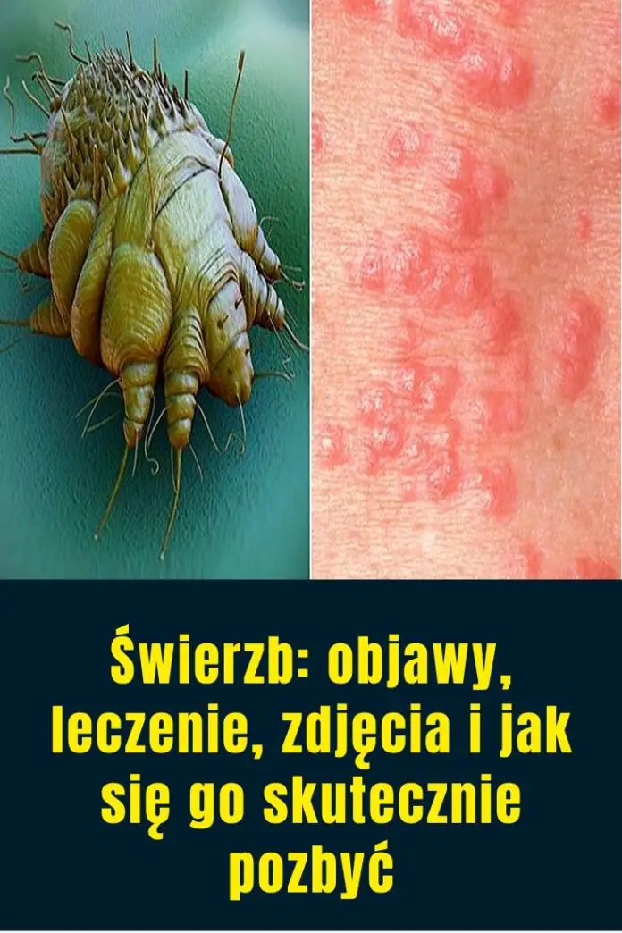 Świerzb Objawy Leczenie Zdjęcia I Jak Się Go Skutecznie Pozbyć