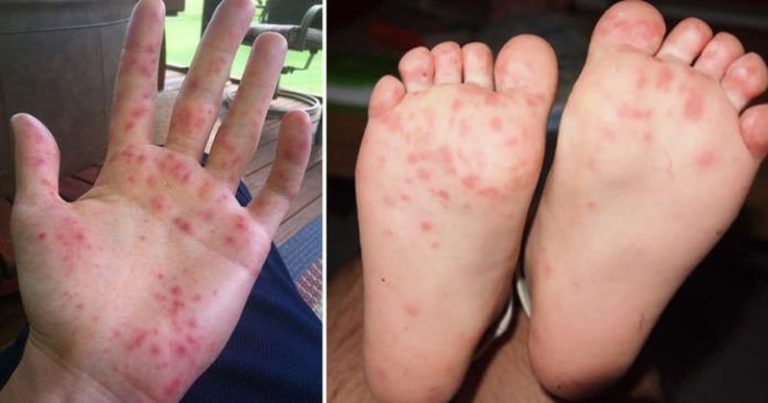 Bostonka (choroba bostońska): objawy, leczenie, wysypka