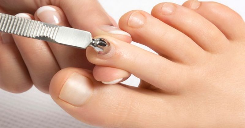 Grzybica paznokci: informacje, leczenie, objawy oraz leki