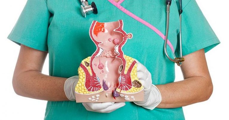 Hemoroidy objawy, przyczyny i leczenie