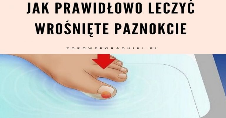 Jak prawidłowo leczyć wrośnięte paznokcie