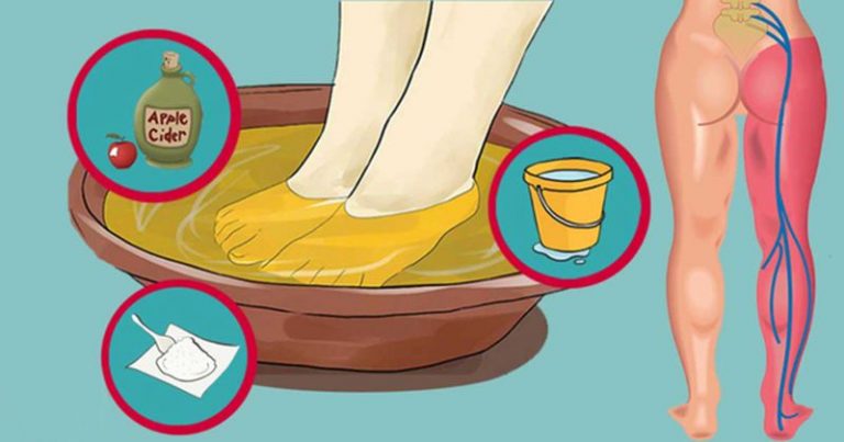 Rwa kulszowa objawy, przyczyny, leczenie, ćwiczenia