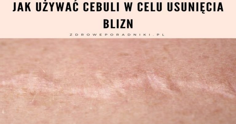cebuli w celu usunięcia blizn