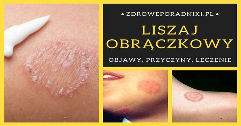 Liszaj Obrączkowy: Objawy, Przyczyny I 2 Sposoby Leczenia