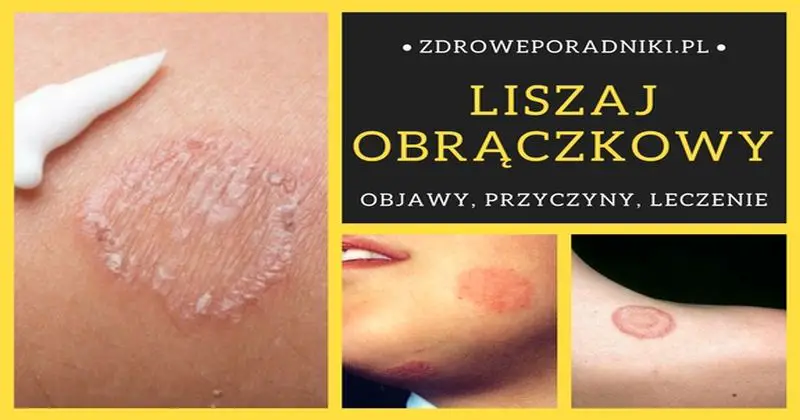 Liszaj Obrączkowy Objawy Przyczyny I 2 Sposoby Leczenia