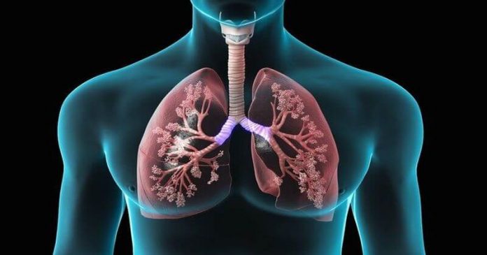 Zapalenie Płuc Objawy Przyczyny Leczenie I Czynniki Ryzyka 4969