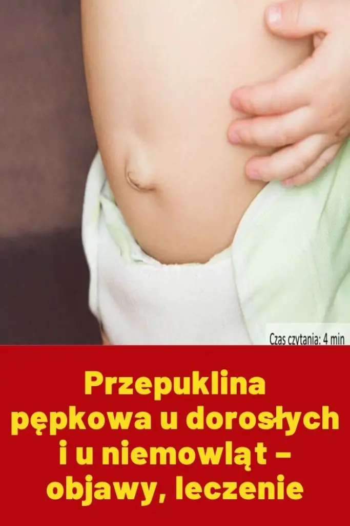 Przepuklina Pępkowa U Dorosłych I U Niemowląt Objawy Leczenie 9840