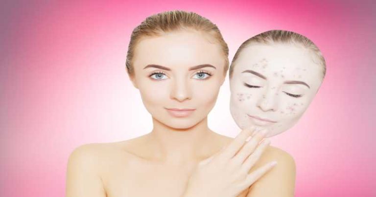 Jak pozbyć się pryszczy