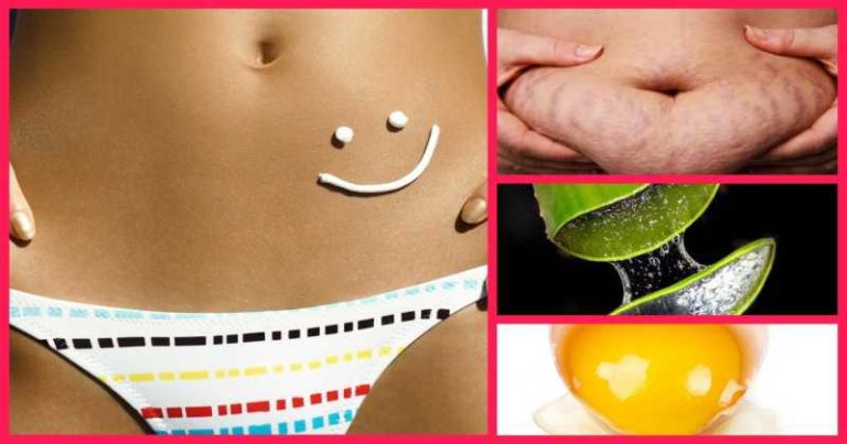 jak pozbyć się rozstępów, rozstępy