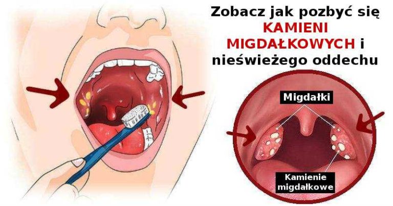 kamienie migdałkowe