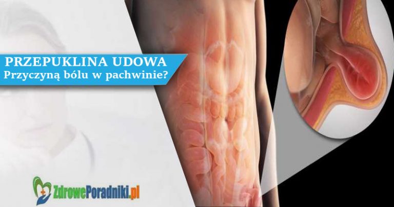 przepuklina udowa