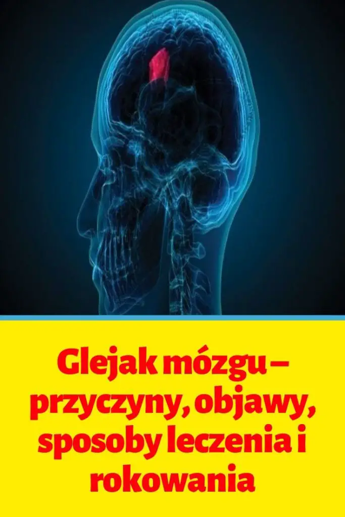 Glejak M Zgu Przyczyny Objawy Sposoby Leczenia I Rokowania