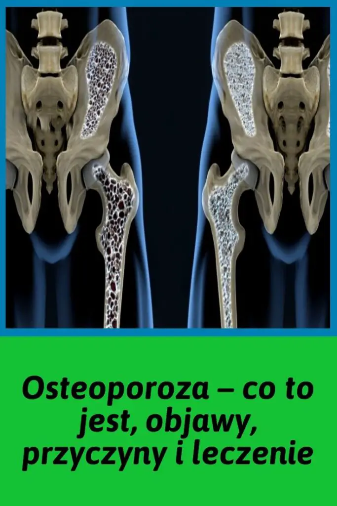 Osteoporoza Co To Jest Objawy Przyczyny I Leczenie 6181