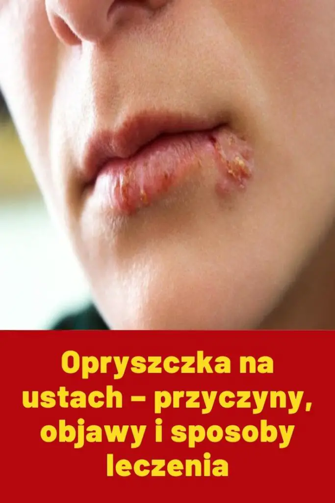 Opryszczka Na Ustach Przyczyny Objawy I Sposoby Leczenia 7527