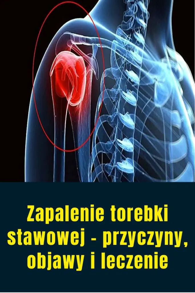 Zapalenie Torebki Stawowej Przyczyny Objawy I Leczenie 7549