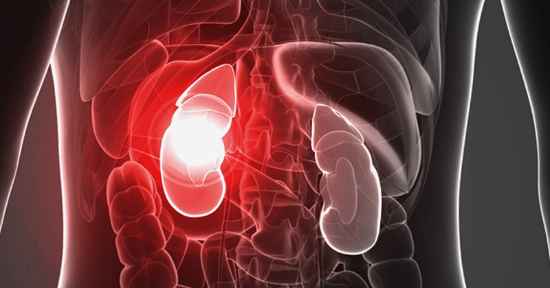 Ostra niewydolność nerek - przyczyny, objawy, leczenie diagram of kidney pain 