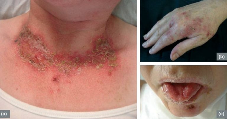 Pelagra (rumień lombardzki)