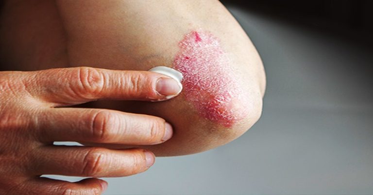 Łuszczycowe zapalenie stawów