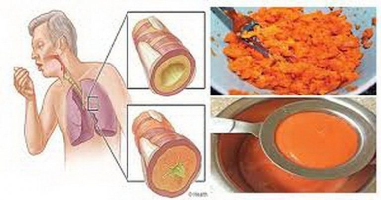 pozbądź się flegmy