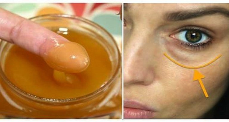 ciemne kręgi pod oczami