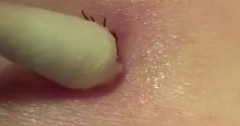 jak wyjąć kleszcza