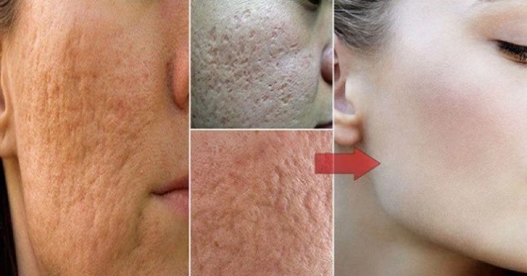 pryszcze trądzik pory