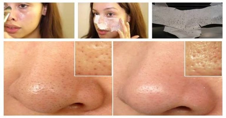 maseczka zaskórniki