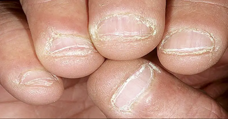 obgryzanie paznokci