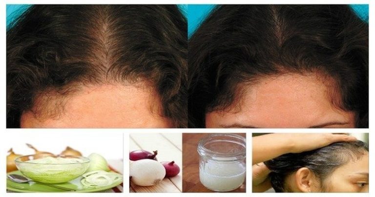 cebula wzrost włosów