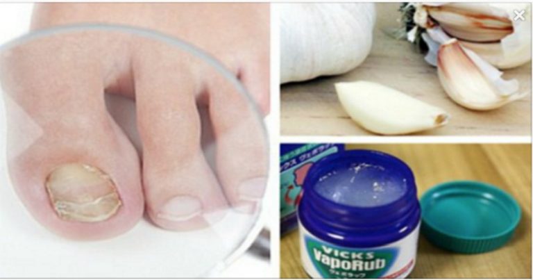 Sprawdzone domowe środki do walki z grzybicą paznokci