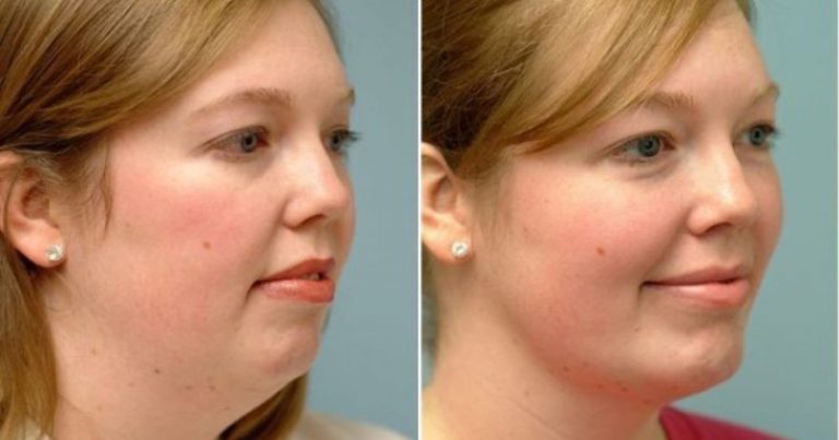 podwójny podbródek