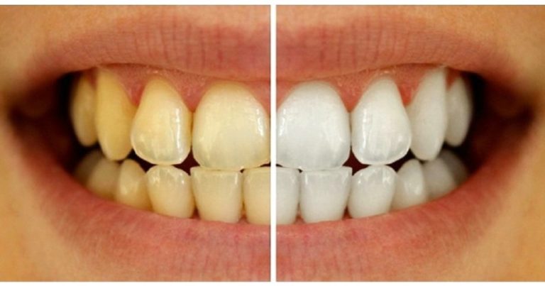 7 niesamowitych sposobów na wybielanie zębów w naturalny sposób