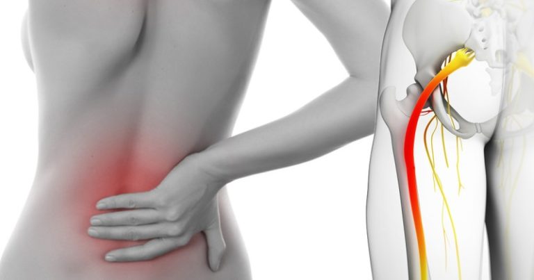 zloty środek na rwę kulszową