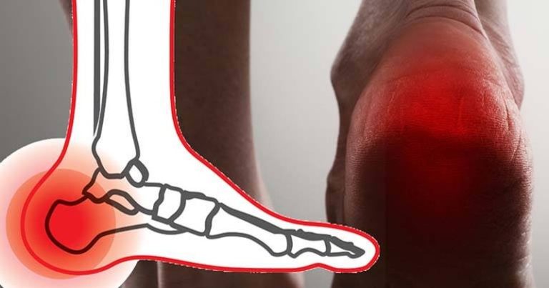 zapalenie powięzi podeszwy