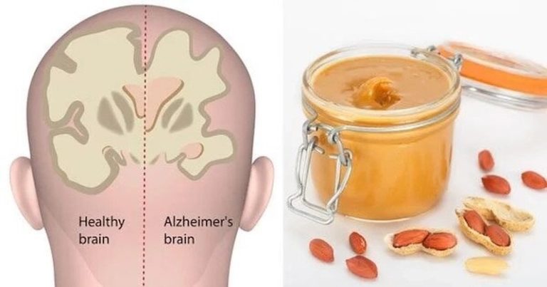Oto jak możesz użyć masła orzechowego do zdiagnozowania choroby Alzheimera!