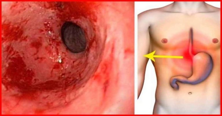zapalenie błony żołądka