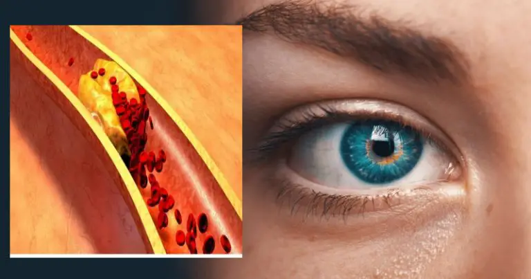 Objawy wysokiego cholesterolu: Znak ostrzegawczy w oku – może prowadzić do ślepoty